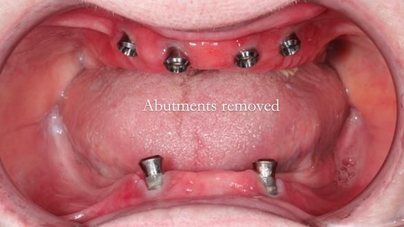 Newsletter 65 Marisa Provision of Complete Dentures on badly placed implants