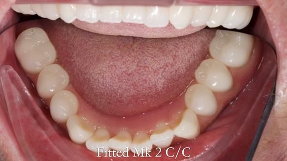 Replacing Madeline’s Complete denture FULL PROTOCOL