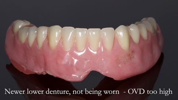 Newsletter 44 - extreme removable prosthodontics – engineering a super-strong and ultra-thin over denture