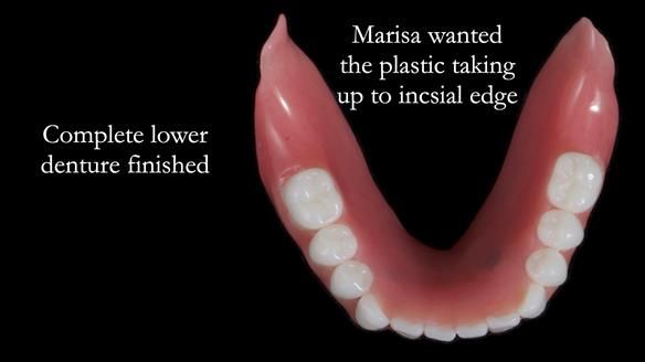 Newsletter 65 Marisa Provision of Complete Dentures on badly placed implants