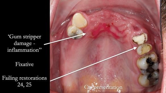 How Keith’s combat denture transformed his life – Newsletter 73