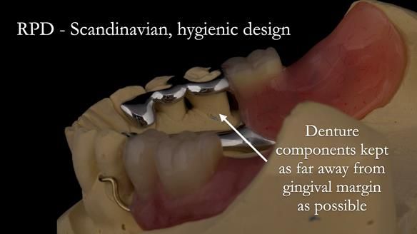 Solving Linda’s Failed “All on 4” implant bridges - full protocol Newsletter 42