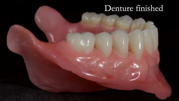 Newsletter 68 Restoring Jan’s Smile: Complete Dentures Inspired by Her Daughter’s Teeth - Post Mouth Surgery