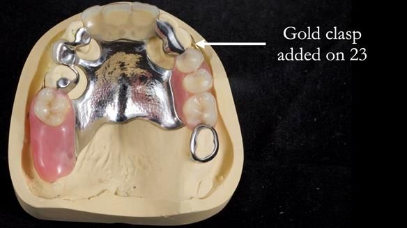 Managing Edgar “THE SCEPTIC” with an RPD/Splint FULL CASE