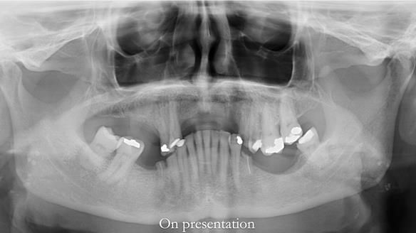 How Keith’s combat denture transformed his life – Newsletter 73