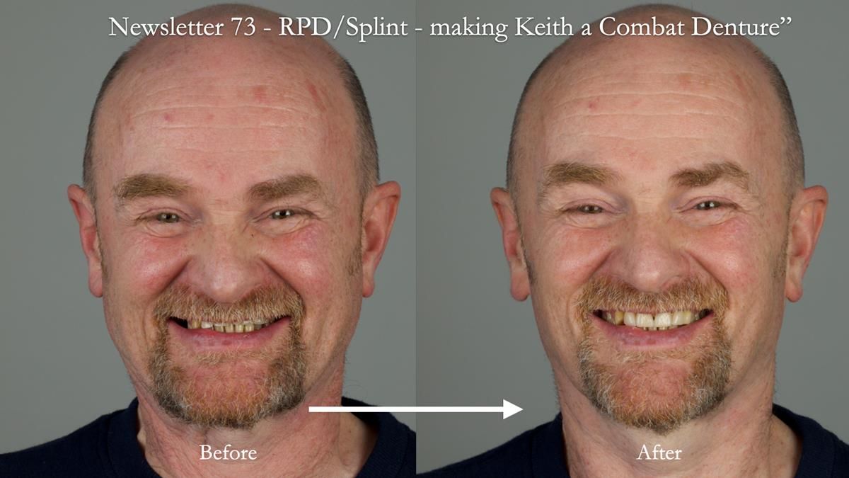 How Keith’s combat denture transformed his life – Newsletter 73