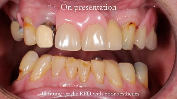 Managing Edgar “THE SCEPTIC” with an RPD/Splint FULL CASE