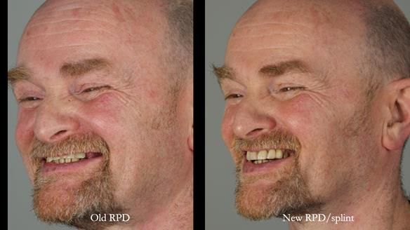 How Keith’s combat denture transformed his life – Newsletter 73