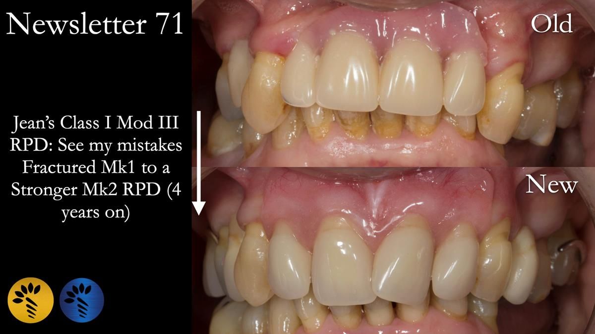 Newsletter 71 Jean’s Class I Mod III RPD: See my mistakes Fractured Mk1 to a Stronger Mk2 RPD (4 years on)