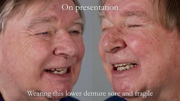 Newsletter 44 - extreme removable prosthodontics – engineering a super-strong and ultra-thin over denture