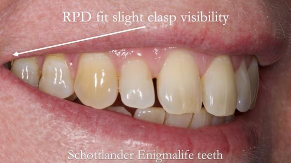 Solving Sue's failed implants with metal based RPD - full protocol Newsletter 43