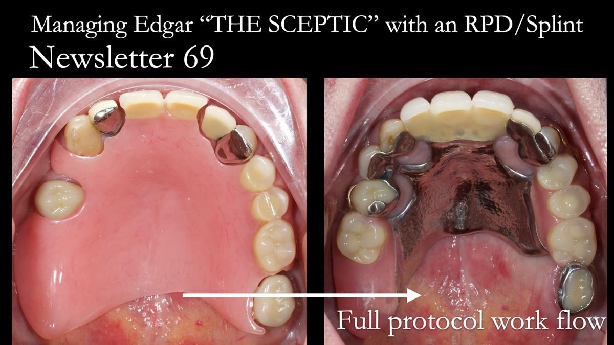 Managing Edgar “THE SCEPTIC” with an RPD/Splint FULL CASE