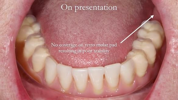 Replacing Madeline’s Complete denture FULL PROTOCOL