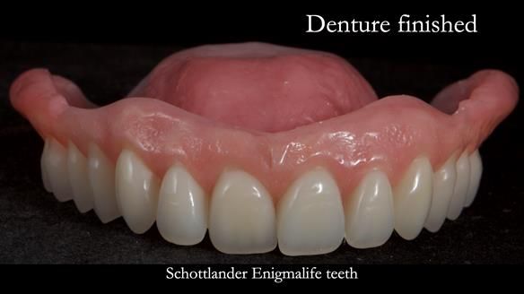 Newsletter 70 Complete Denture Treatment for Kate: A Case Study on Natural-Looking Dentures and Implant-Supported Overdentures