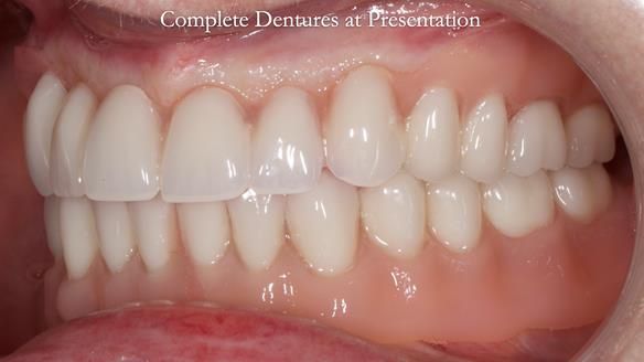 Newsletter 70 Complete Denture Treatment for Kate: A Case Study on Natural-Looking Dentures and Implant-Supported Overdentures