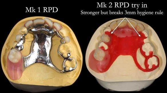 Newsletter 71 Jean’s Class I Mod III RPD: See my mistakes Fractured Mk1 to a Stronger Mk2 RPD (4 years on)