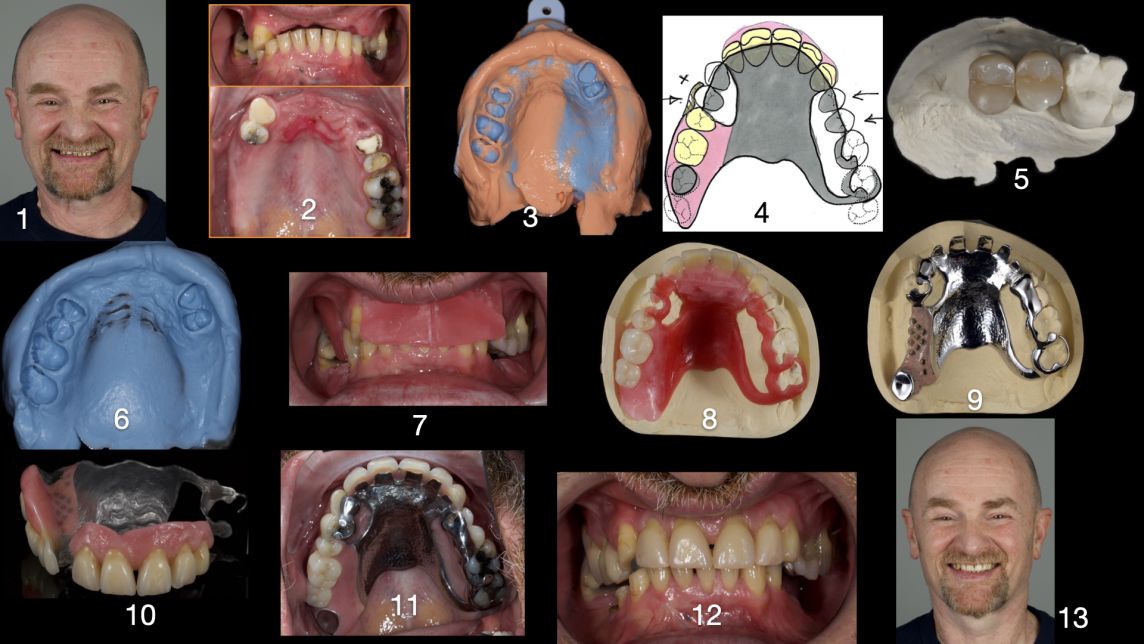 Finlay Sutton's Study Club 8 Keith's Class I Div I metal based Mx Scandinavian style partial denture