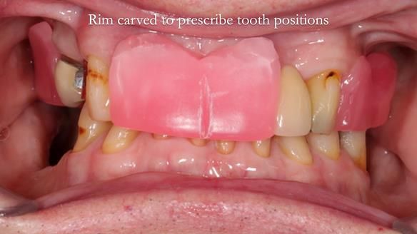 Managing Edgar “THE SCEPTIC” with an RPD/Splint FULL CASE