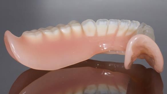 Newsletter 70 Complete Denture Treatment for Kate: A Case Study on Natural-Looking Dentures and Implant-Supported Overdentures