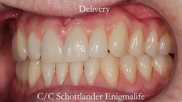 Newsletter 48 Mavis's Complete denture FULL PROTOCOL