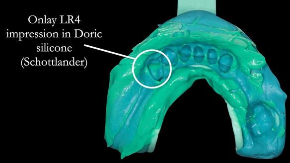 Eileen's transformation with upper and lower RPDs of Scandinavian hygienic design FULL PROTOCOL