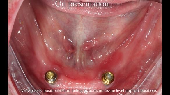 Newsletter 65 Marisa Provision of Complete Dentures on badly placed implants