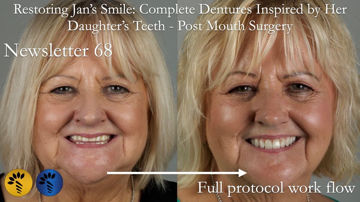 Newsletter 68 Restoring Jan’s Smile: Complete Dentures Inspired by Her Daughter’s Teeth - Post Mouth Surgery