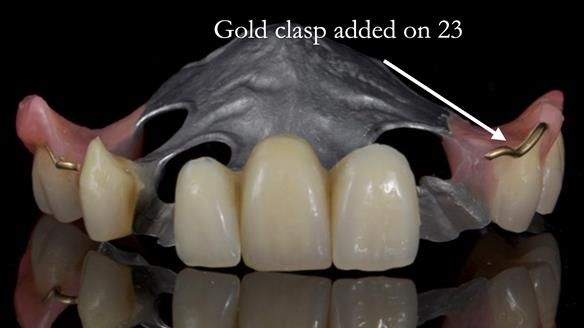 Managing Edgar “THE SCEPTIC” with an RPD/Splint FULL CASE