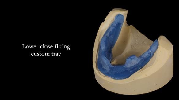 Newsletter 68 Restoring Jan’s Smile: Complete Dentures Inspired by Her Daughter’s Teeth - Post Mouth Surgery