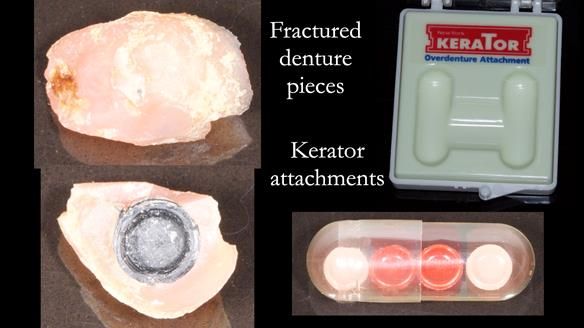 Newsletter 44 - extreme removable prosthodontics – engineering a super-strong and ultra-thin over denture