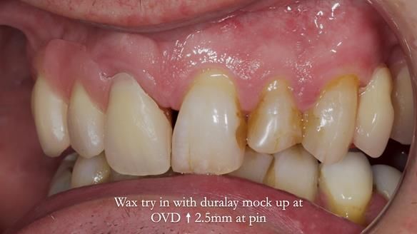 Read Newsletter 67 - Brian's COMBAT DENTURE Case Study