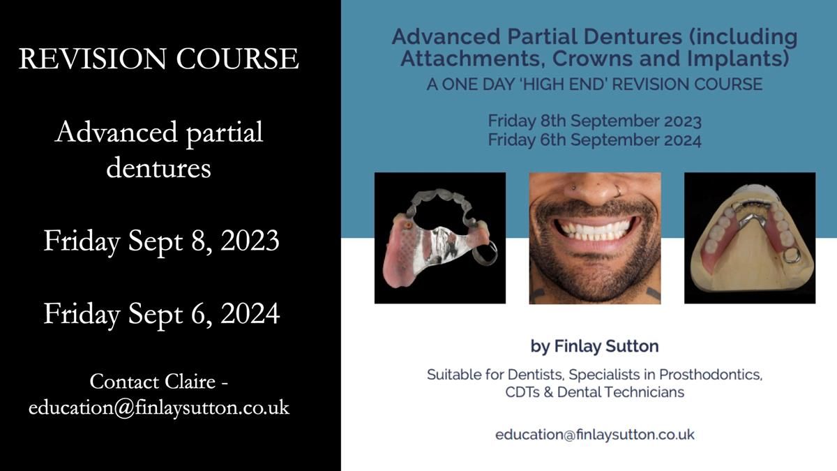 Newsletter 44 - extreme removable prosthodontics – engineering a super-strong and ultra-thin over denture