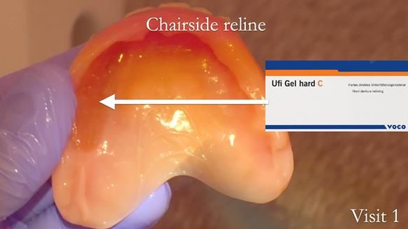 Newsletter 49 Managing Estelle’s failing implants with dentures FULL PROTOCOL