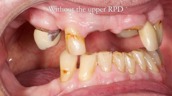 Managing Edgar “THE SCEPTIC” with an RPD/Splint FULL CASE