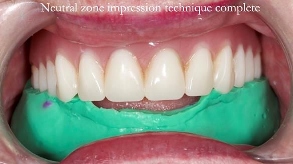 Replacing Madeline’s Complete denture FULL PROTOCOL