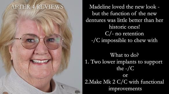 Replacing Madeline’s Complete denture FULL PROTOCOL