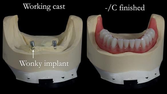 Newsletter 65 Marisa Provision of Complete Dentures on badly placed implants