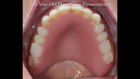 Newsletter 68 Restoring Jan’s Smile: Complete Dentures Inspired by Her Daughter’s Teeth - Post Mouth Surgery