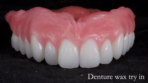 Newsletter 65 Marisa Provision of Complete Dentures on badly placed implants