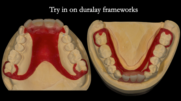  Figure 65 Teeth try in on pattern resin bases. These help to confirm the accuracy of the working casts and the amount of metal work which will be visible in the final dentures