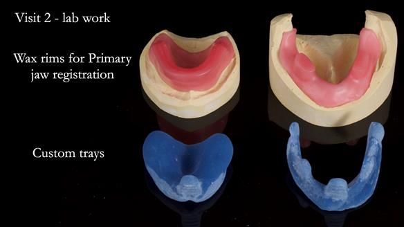 Newsletter 70 Complete Denture Treatment for Kate: A Case Study on Natural-Looking Dentures and Implant-Supported Overdentures