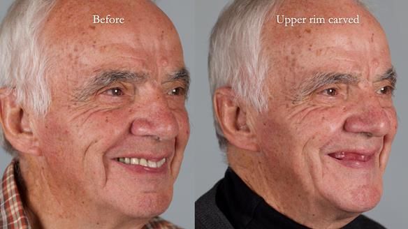 Newsletter 74: Ken’s Case Study Complete Dentures - Life Like and Age Appropriate