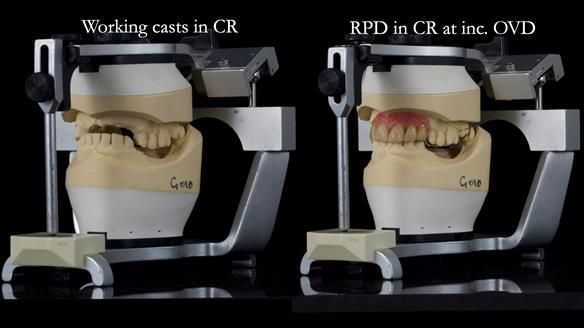 How Keith’s combat denture transformed his life – Newsletter 73