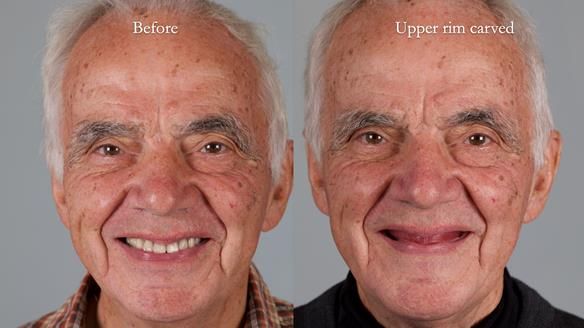 Newsletter 74: Ken’s Case Study Complete Dentures - Life Like and Age Appropriate