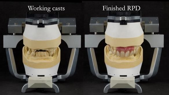 Newsletter 71 Jean’s Class I Mod III RPD: See my mistakes Fractured Mk1 to a Stronger Mk2 RPD (4 years on)