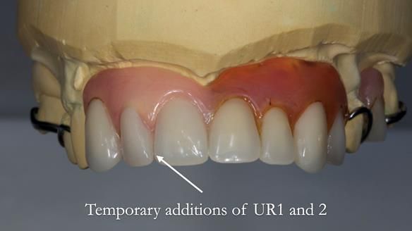 Eileen's transformation with upper and lower RPDs of Scandinavian hygienic design FULL PROTOCOL