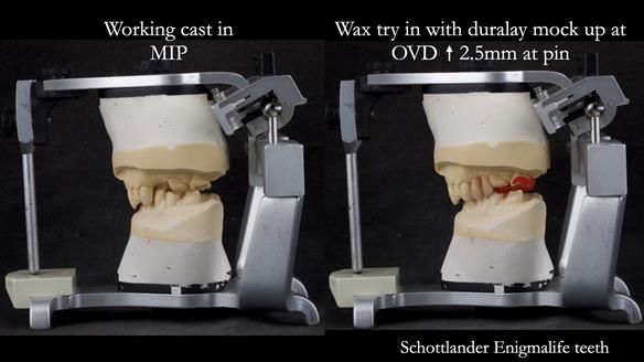 Read Newsletter 67 - Brian's COMBAT DENTURE Case Study