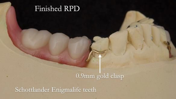 Eileen's transformation with upper and lower RPDs of Scandinavian hygienic design FULL PROTOCOL