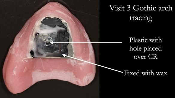 Newsletter 74: Ken’s Case Study Complete Dentures - Life Like and Age Appropriate