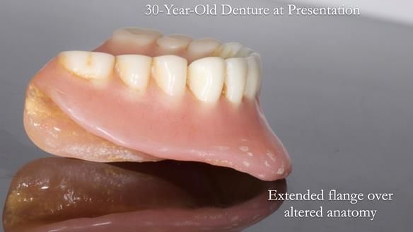 Newsletter 68 Restoring Jan’s Smile: Complete Dentures Inspired by Her Daughter’s Teeth - Post Mouth Surgery